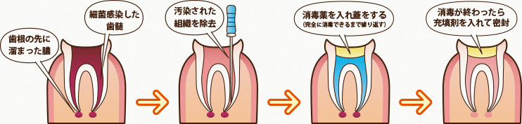 根管治療の流れ