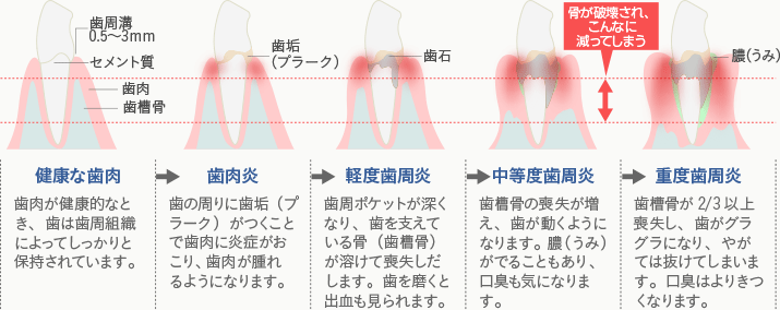 歯周病の症状と進行の様子