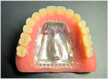 金属床義歯（保険適用外）